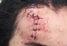 Mulher sofre corte na testa após agressão e companheiro é preso por violência doméstica