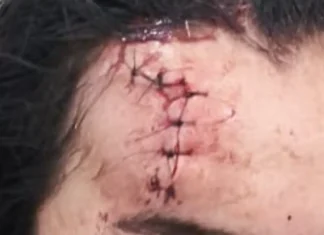 Mulher sofre corte na testa após agressão e companheiro é preso por violência doméstica