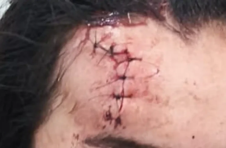 Mulher sofre corte na testa após agressão e companheiro é preso por violência doméstica